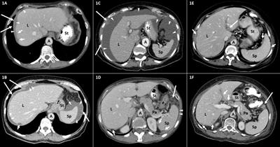 Predicting incomplete cytoreduction in patients with advanced ovarian cancer